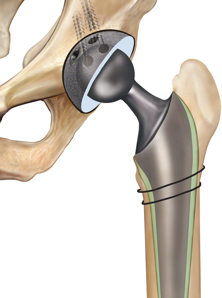 Revision Hip Replacement Dr Anthony Spriggins   10670 Revision Total Hip Replacement ME 765x1024 