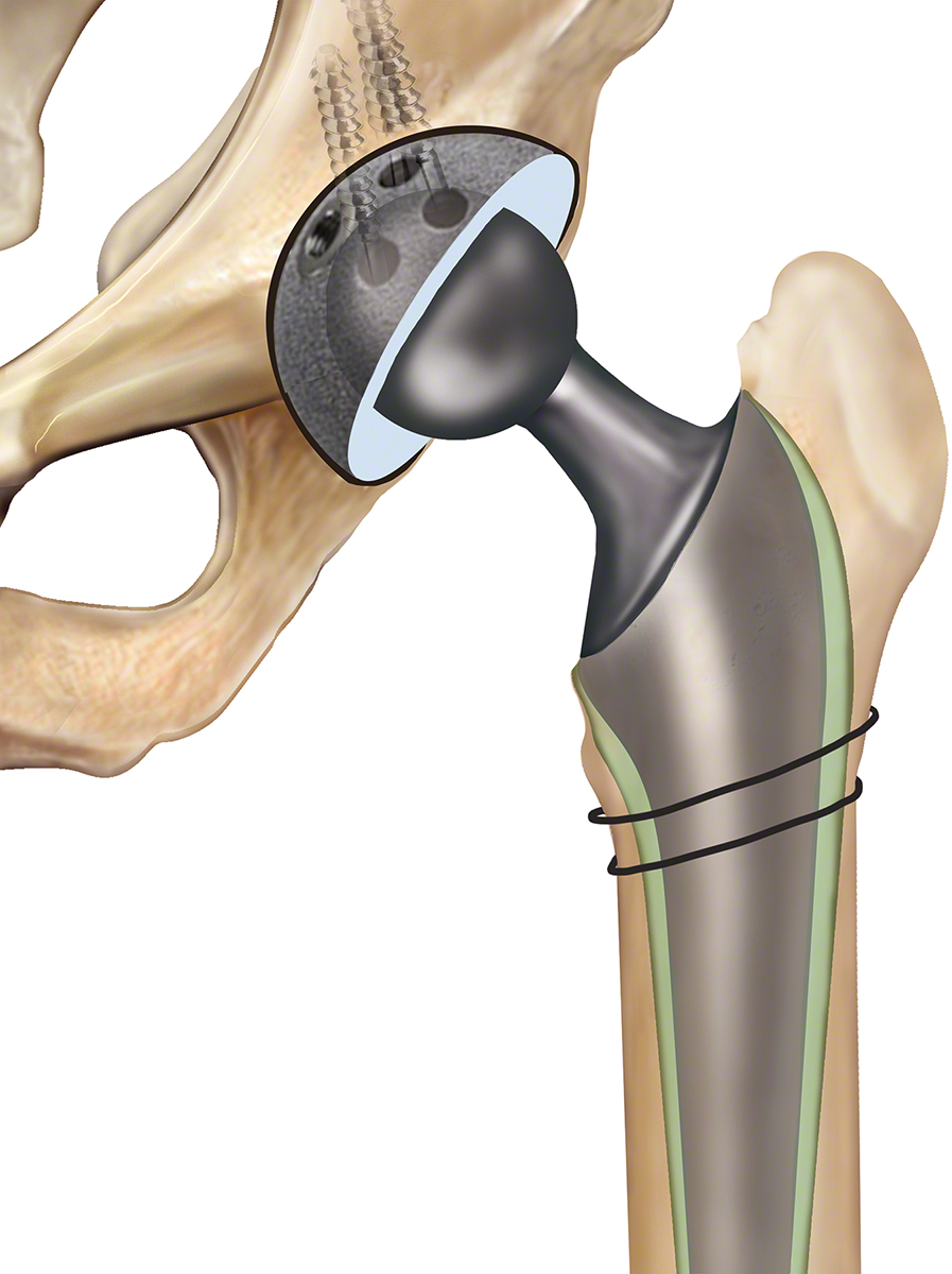 Revision Hip Replacement Dr Anthony Spriggins